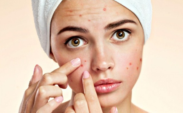 Will Parents Pass Acne Skin to Children?