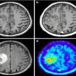 Glowing Chemical Can Aid Brain Cancer Surgery - About Islam